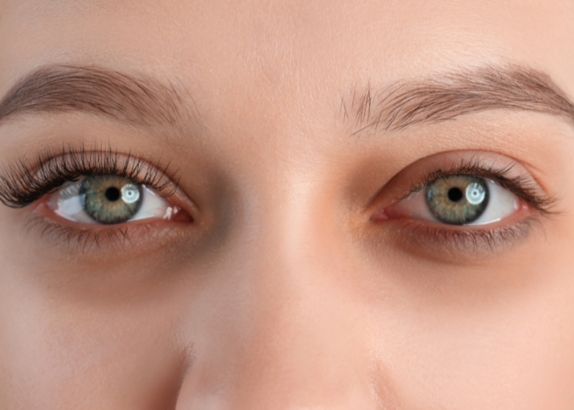 Under eye dark circle treatment