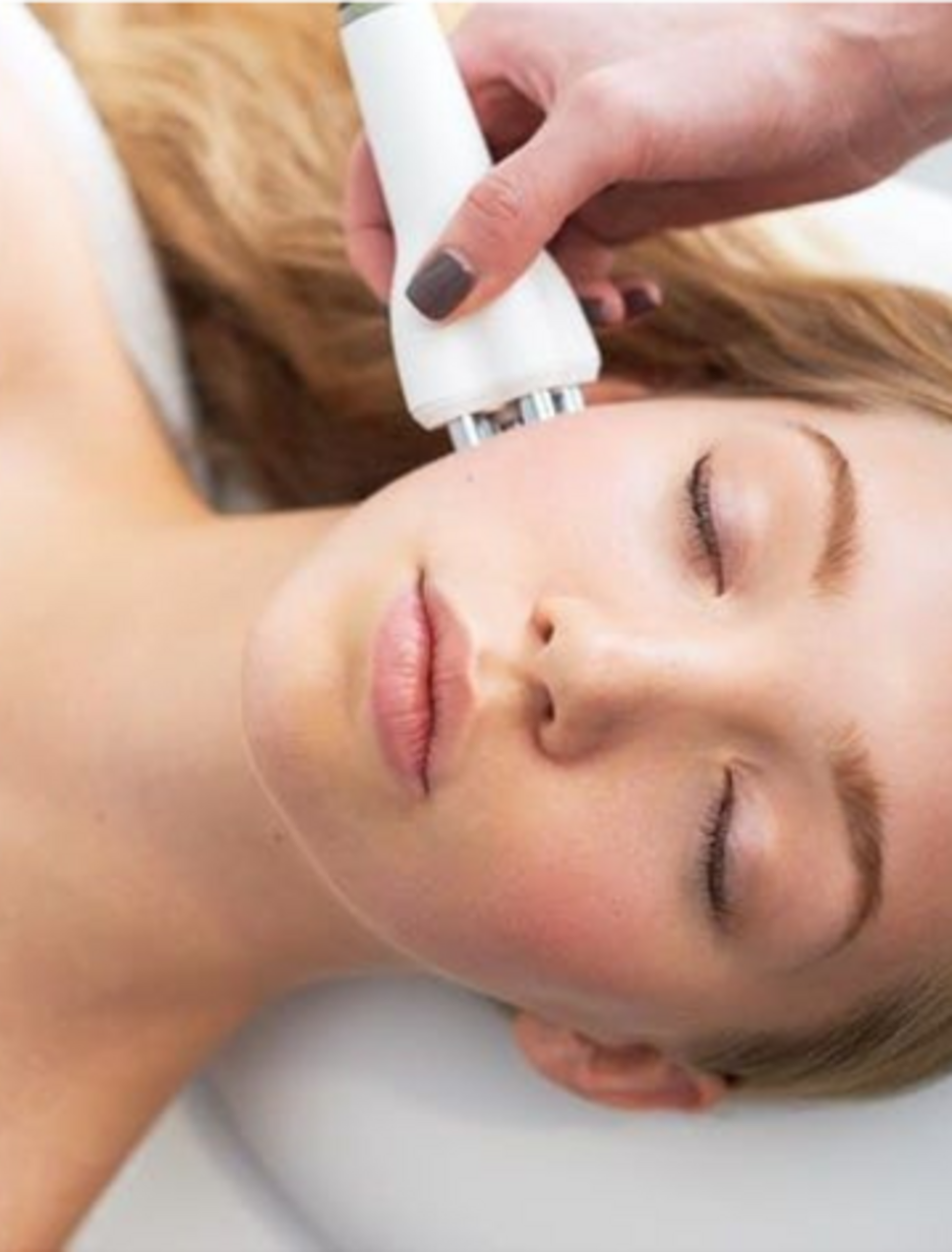 RF Skin Tightening