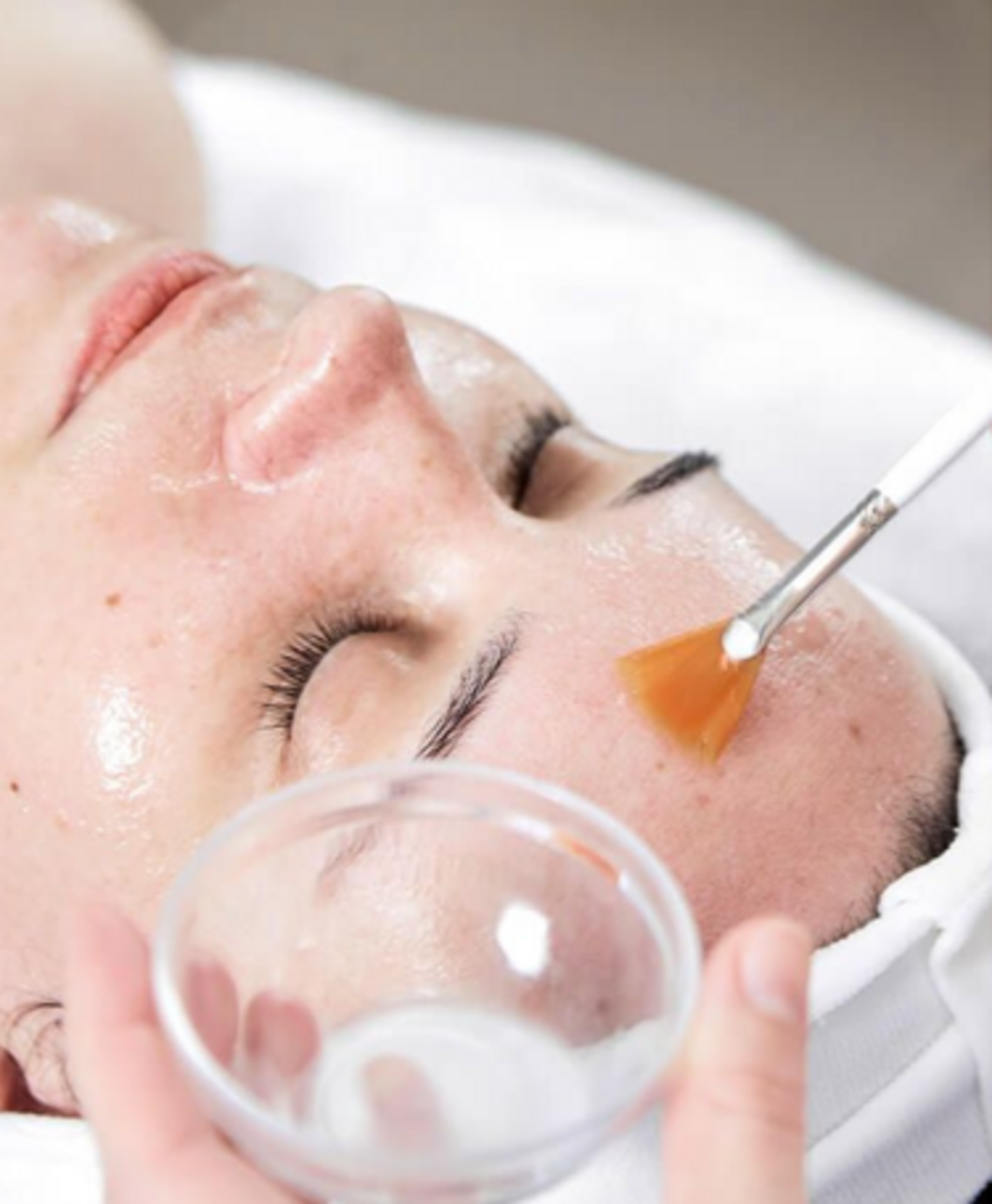 Chemical Peels